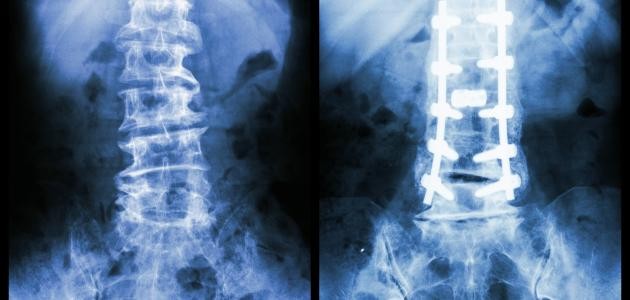 كسور العظام