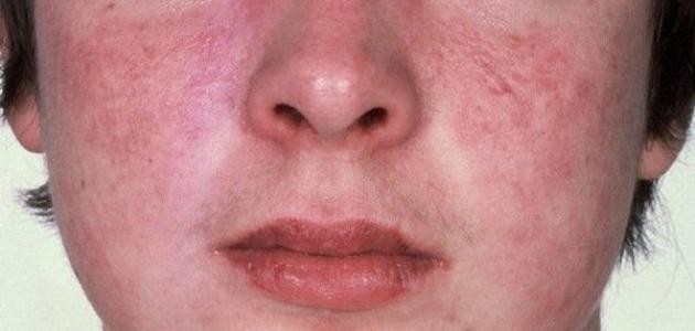 ما هي أعراض نقص صفائح الدم