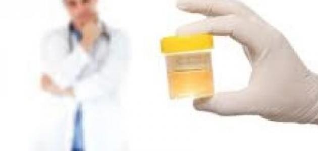 ما هو سبب حرقان البول