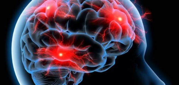 ما هو مرض الصرع