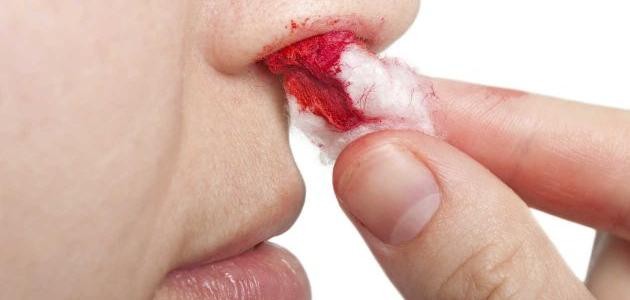 ما أسباب نزول الدم من الأنف