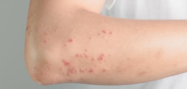 ما أسباب حساسية الجلد