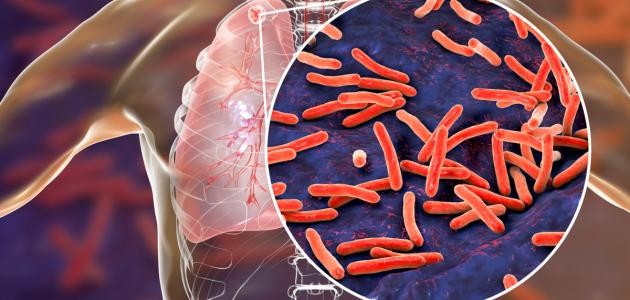 كيفية تشخيص مرض السل