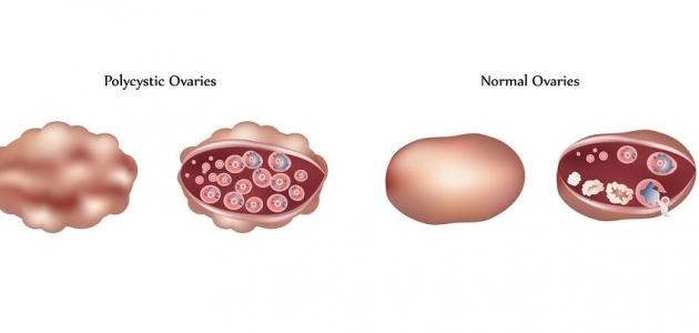 ما هو تكيس المبايض