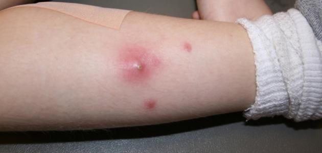 ما هو سبب ظهور الدمامل