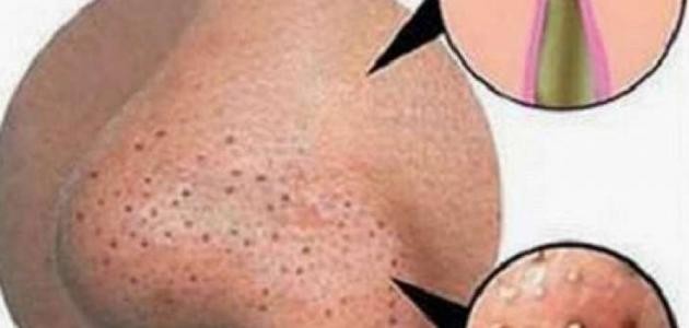 كيفية علاج حب الشباب والرؤوس السوداء