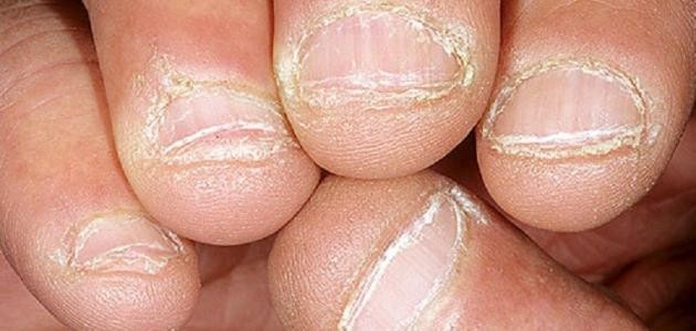 طرق انتقال الزهري