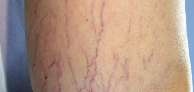 ما هي مضاعفات مرض دوالي الساقين