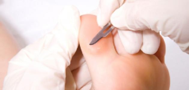 ما هو مسمار اللحم