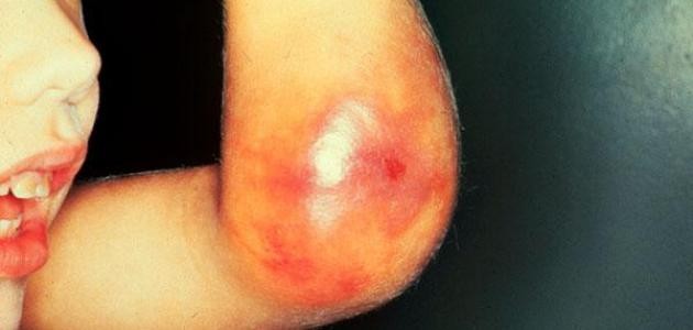 ما هو النزيف الداخلي