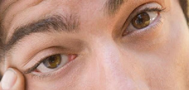 كيف أتخلص من رفة العين