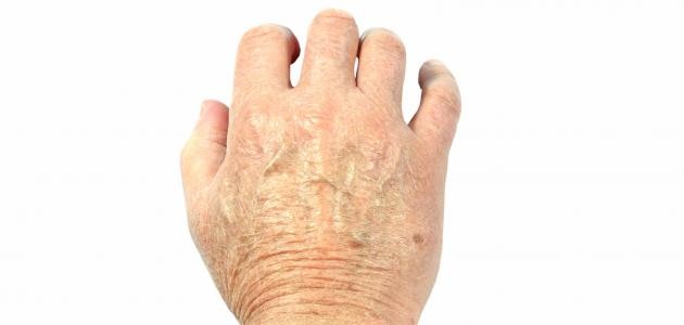 علاج تشقق اليدين