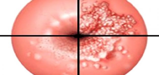 ما هي أعراض قرحة الرحم