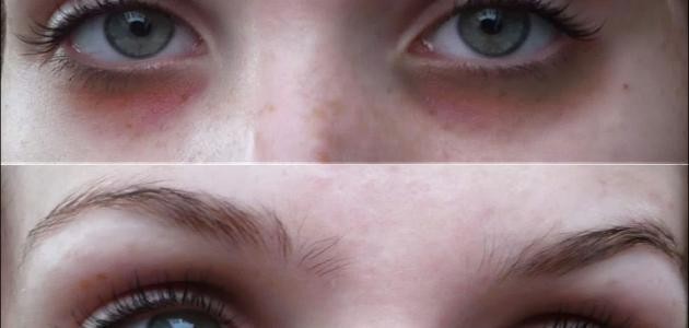 تخفيف السواد تحت العين