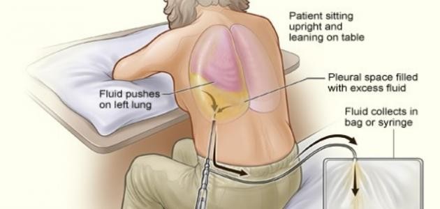 ما هو مرض ذات الجنب