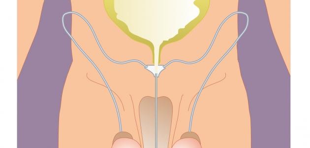 الخصية الهاربة