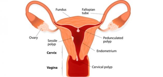 ما هي أعراض لحمية الرحم
