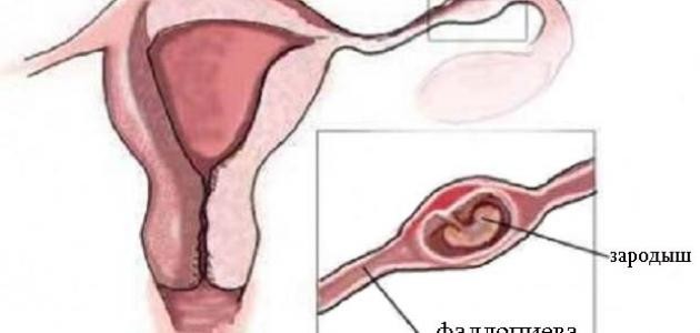 ما هي أعراض وجود كيس على المبيض ما هي أعراض وجود كيس على المبيض