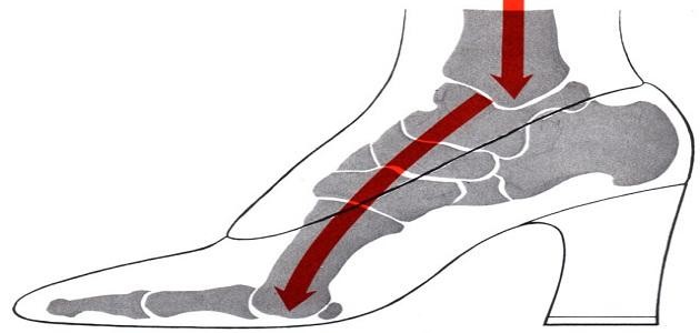 الكعب العالي وأضراره