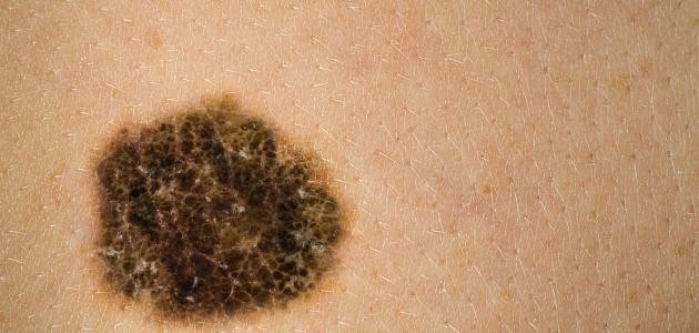 ما هي وحمة بوتر واين (الوحمة الملتهبة) ما هي وحمة بوتر واين (الوحمة الملتهبة)