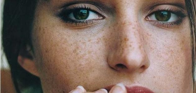 كيف أتخلص من النمش