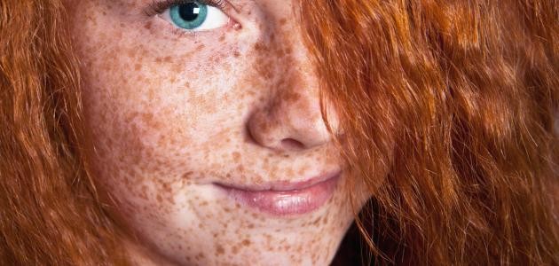 ما هو النمش