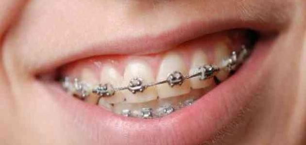 مراحل تقويم الأسنان مراحل تقويم الأسنان