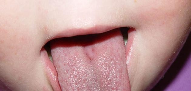 ما هو علاج ثقل اللسان