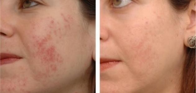 كيف أقضي على آثار حب الشباب