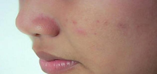 ما علاج حب الشباب في الوجه