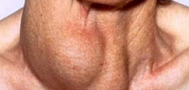 ما علاج تضخم الغدد اللمفاوية