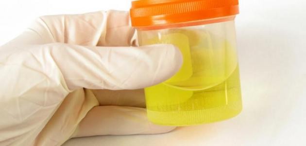 ما هي أعراض زلال البول