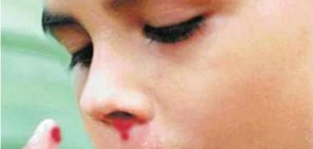 ما هي أسباب نزول الدم من الأنف