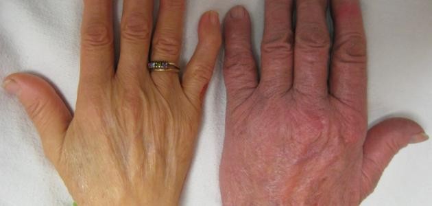 تعريف فقر الدم