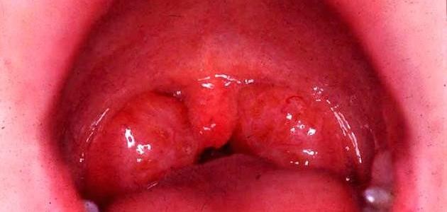 ما هو ميكروب الدم ما هو ميكروب الدم