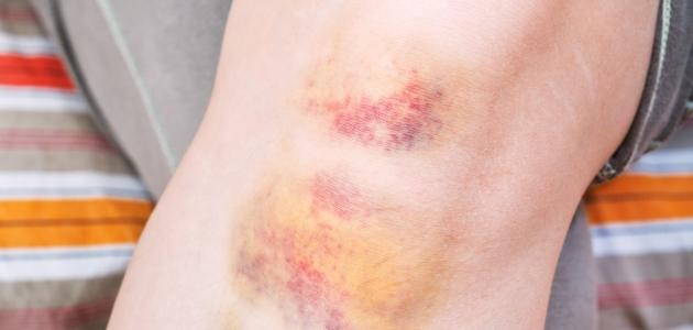 ما سبب خشونة الركبة