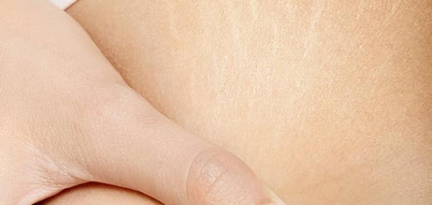 كيف ازيل تشققات البطن