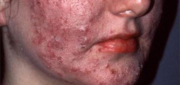 ما هو داء الحفر