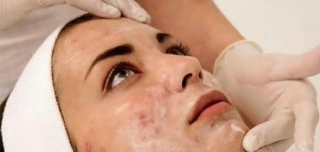 حبوب الشباب وعلاجها