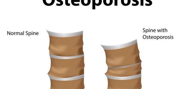 ما هو ترقق العظام