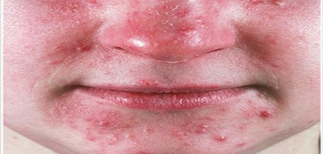 كيف تعالج احمرار الوجه
