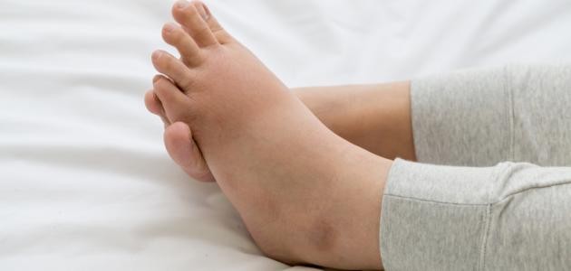 ما هي أسباب تورم القدم ما هي أسباب تورم القدم