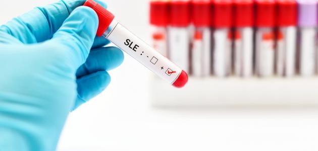 ما هي الذئبة الحمراء