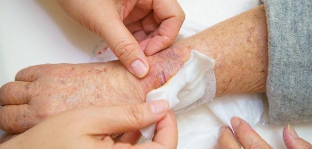 كيفية علاج الجروح لمرضى السكري