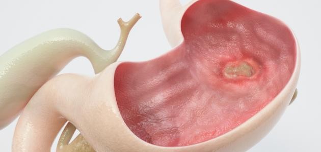 ما هي أسباب قرحة المعدة ما هي أسباب قرحة المعدة