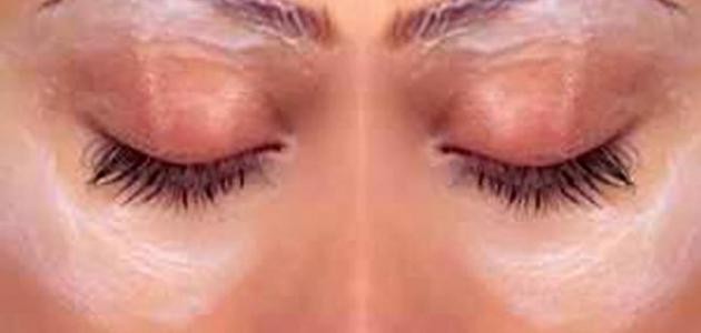 ما علاج السواد حول العينين
