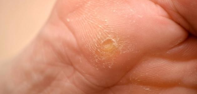 ما هو علاج عين السمكة