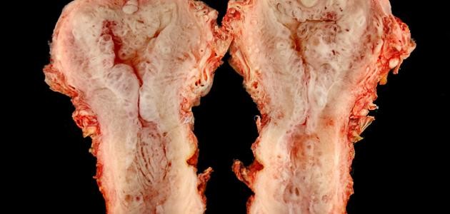 ما هو ضمور الرحم