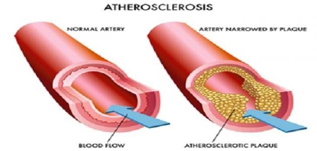 ما هو تحليل الدهون الثلاثية